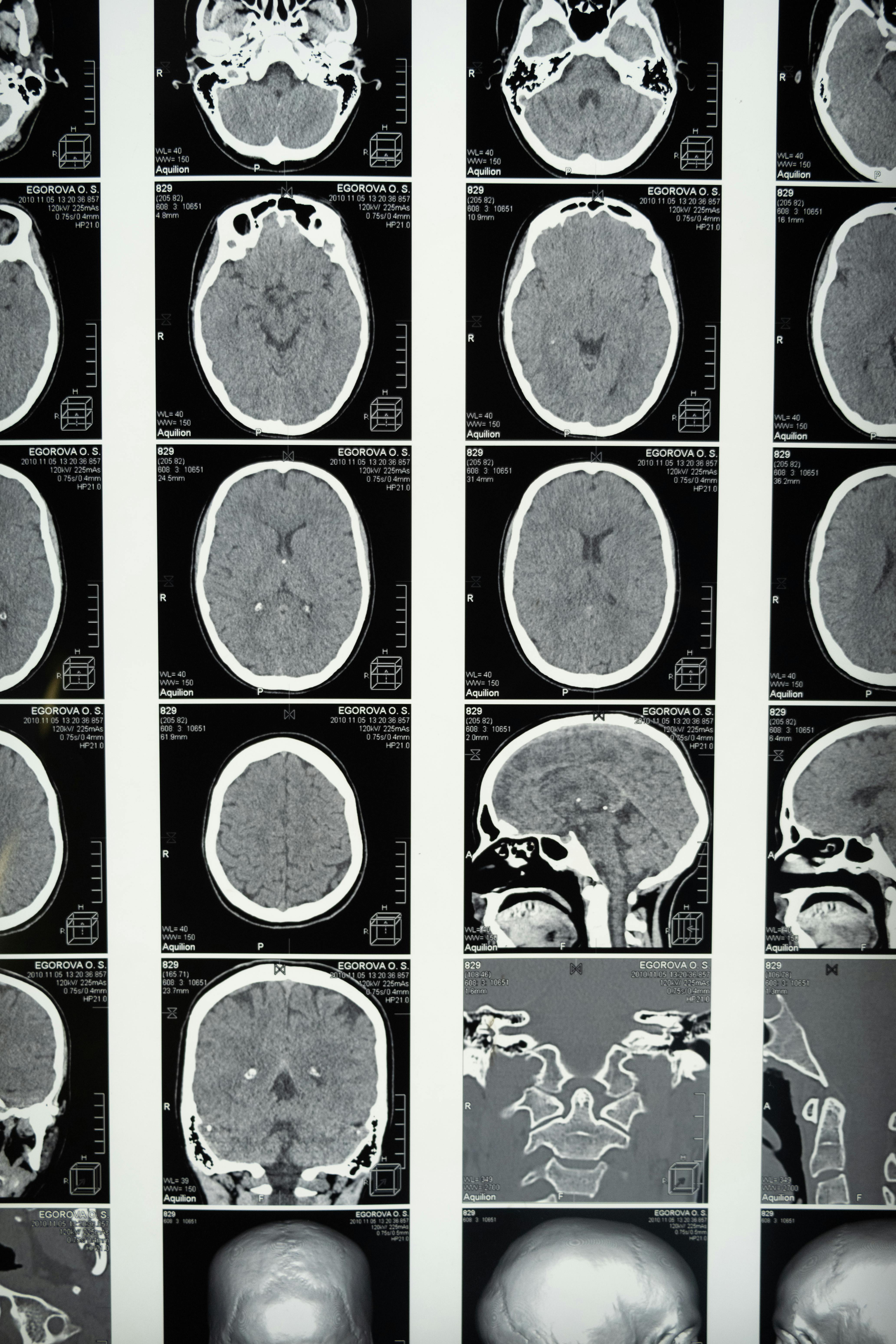 Comprehensive set of brain MRI scans highlighting cranial anatomy for medical use